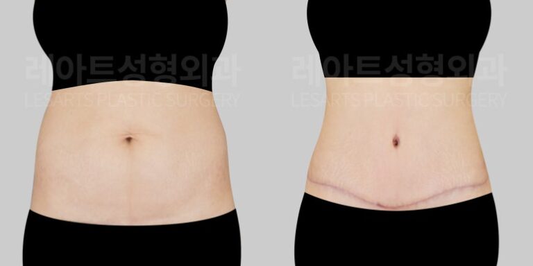 l-abdominoplasty-post28-02