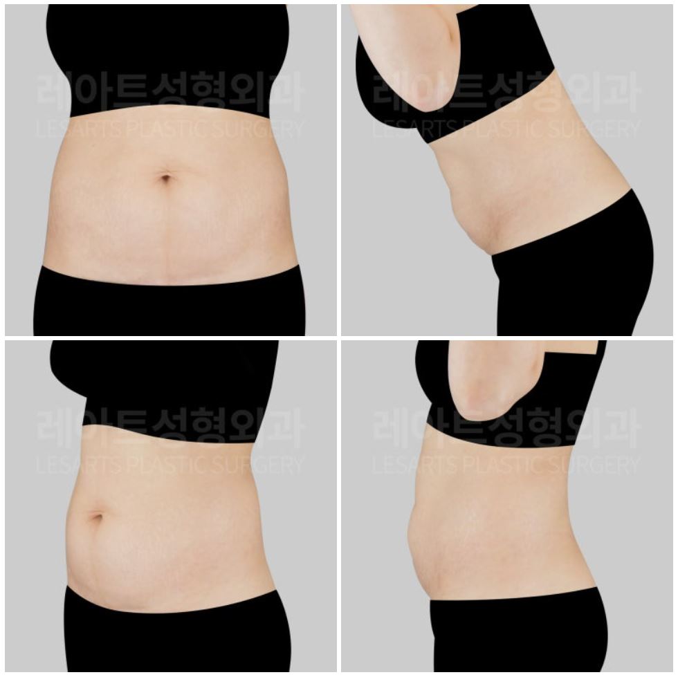 l-abdominoplasty-post28