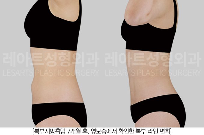 복부 지방흡입 전후사진 - 레아트성형외과