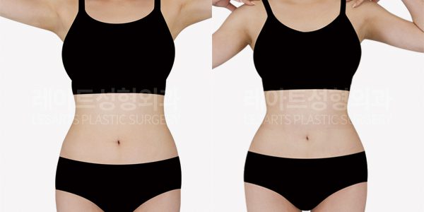 복부지방흡입 전후사진-레아트성형외과