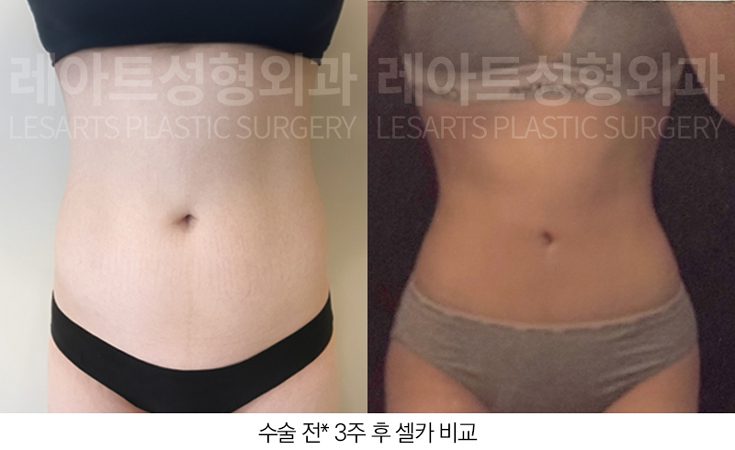 복부 지방흡입 전후 셀카 사진
