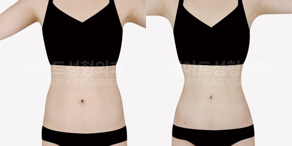 레아트 복부지방흡입 전후사진 비교