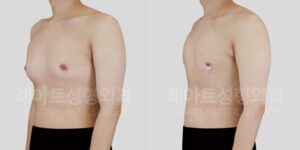 여유증 수술 2주후 전후 비교사진