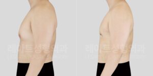 여유증 수술 전후 레아트 성형외과