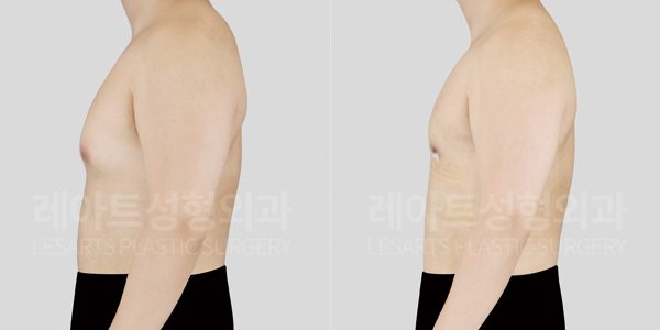 여유증 수술 전후 레아트 성형외과