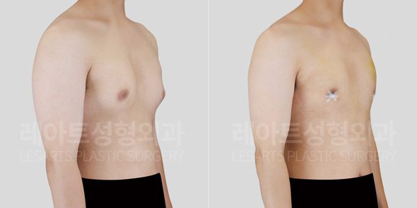 여유증 수술 전후 비교 모습 - 레아트성형외과