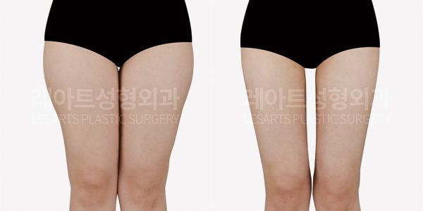 허벅지지방흡입 - 레아트성형외과