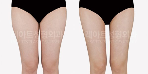 허벅지 지방흡입 전후사진 - 레아트 성형외과