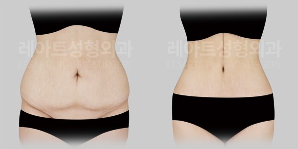 복부거상술 전후 비교 모습 - 레아트 성형외과