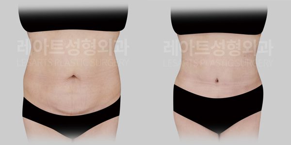 복부거상 전후사진 - 레아트 성형외과