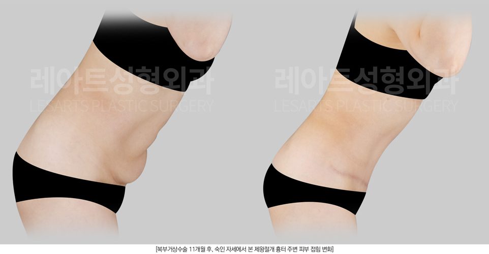 복부거상술로 처진뱃살 교정 - 레아트성형외과