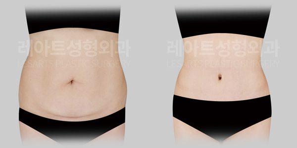 복부거상 수술 전후 앞모습 - 레아트 성형외과