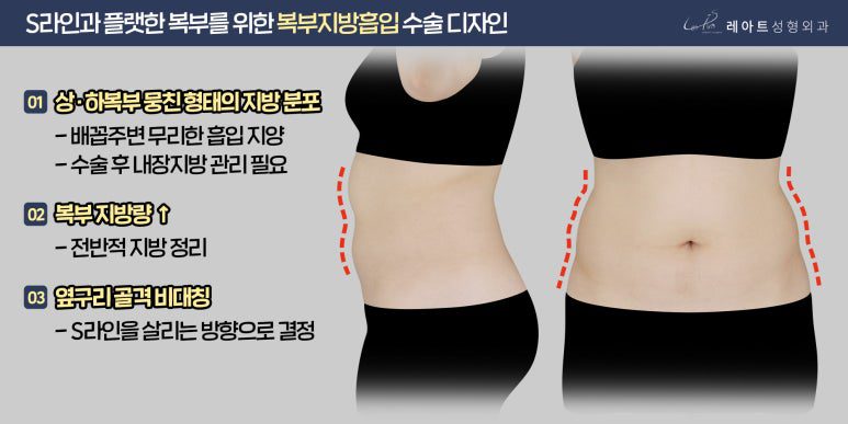 예비신부 복부 지방흡입 수술 계획 - 레아트 서용승원장