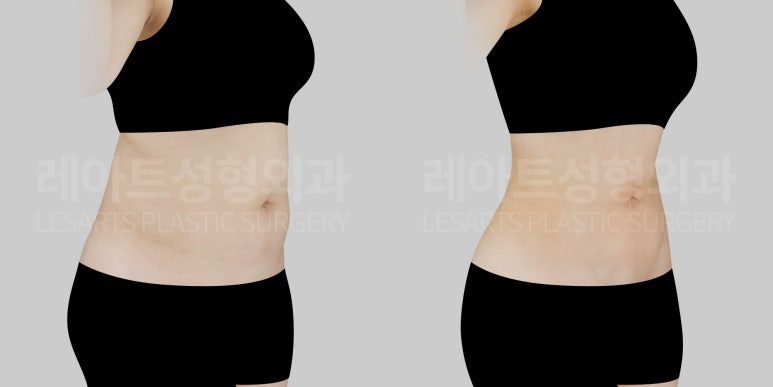 결혼전 뱃살 지방흡입 후기