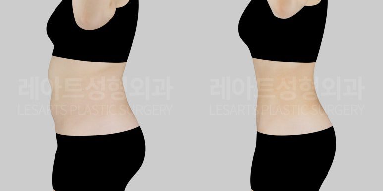 지방흡입으로 뱃살 뺴기 - 레아트성형외과 서용승원장