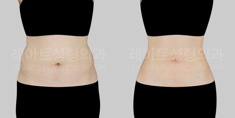 복부 지방흡입 (앞복부, 옆구리, 러브핸들)전후