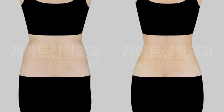 복부 지방흡입 전후 뒷모습