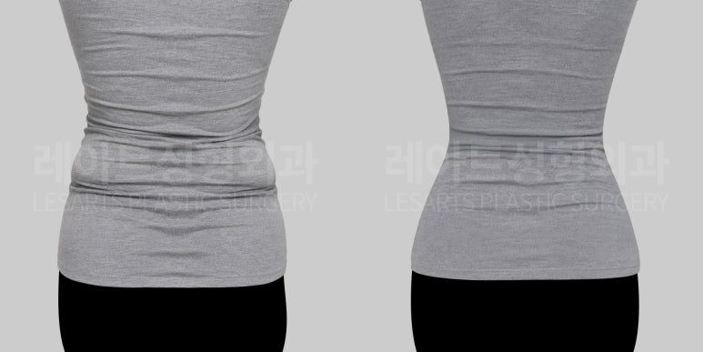 옆구리 지방흡입 후 허리라인 옷 핏 변화