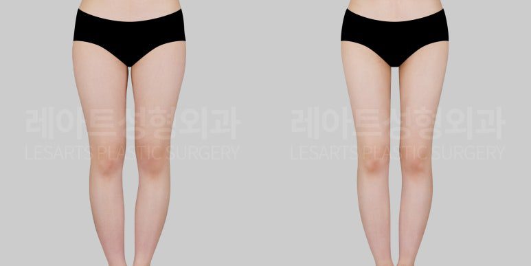 허벅지 지방흡입 앞모습 전후 비교 - 레아트 성형외과
