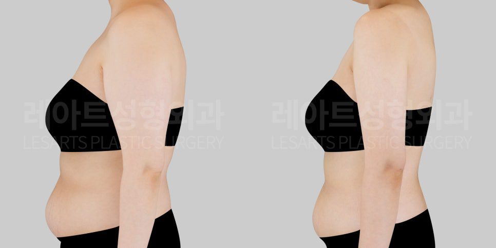 팔지방흡입 전후사진 - 레아트 성형외과