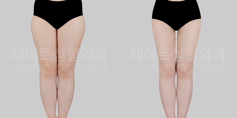 동시에 시행한 허벅지 지방흡입, 골반성형의 전후 차이 - 레아트 성형외과