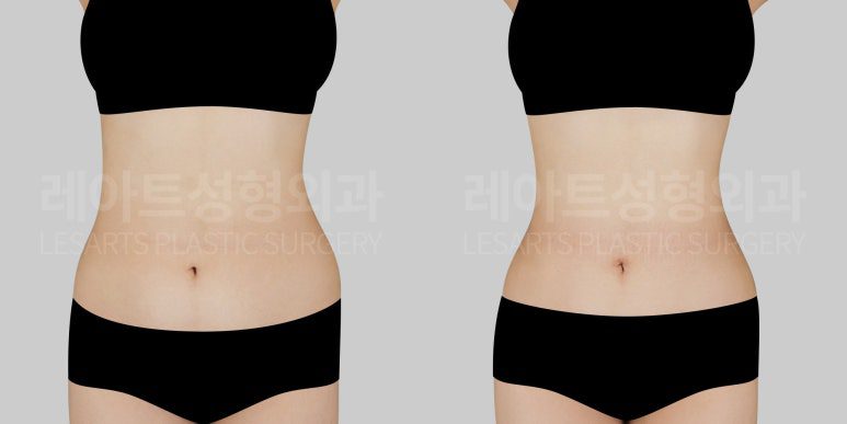 복부지방흡입 전후 비교