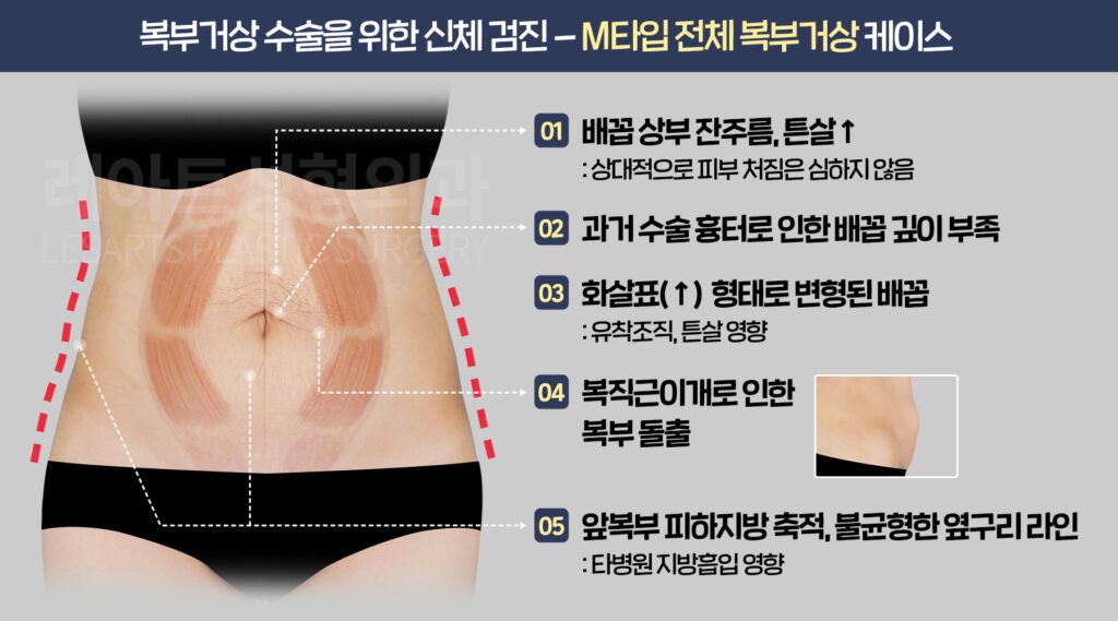 복부거상 수술 전 진단-레아트성형외과
