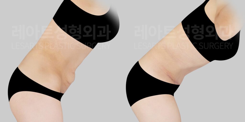 전체 복부거상 전후 피부 처짐 차이 - 레아트성형외과