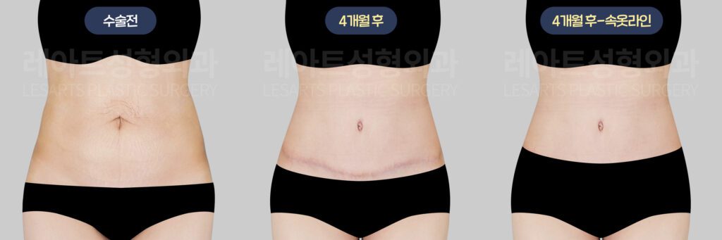 전체 복부거상술 절개, 흉터 위치 - 레아트 이국한 원장
