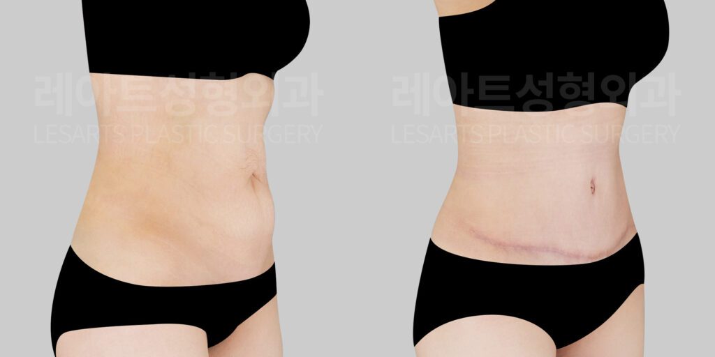 복부거상 수술을 통한 복벽 돌출 개선 - 레아트 이국한 원장