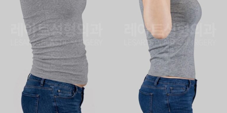 복부거상|임신-출산 후 복부거상수술, 결과는 잘 유지될까? 6개월 vs 1년 비교