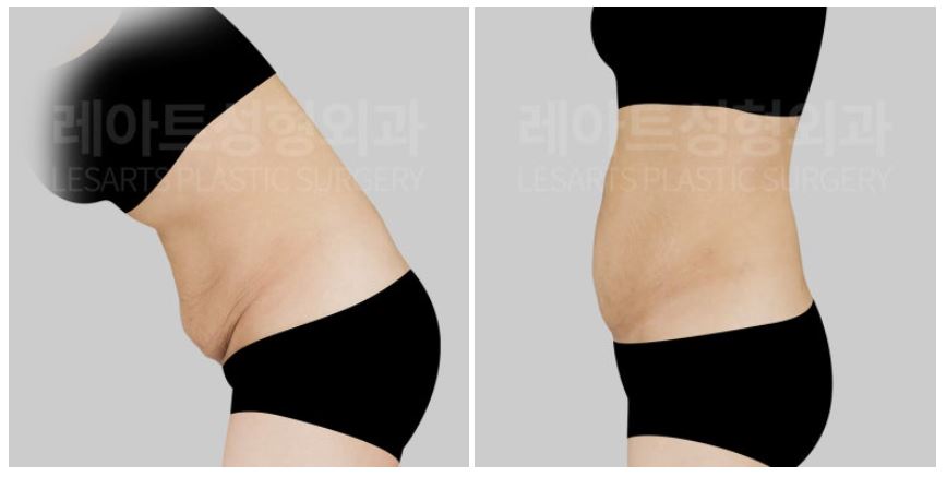 복부거상 수술 전 상태 - 복직근 이개, 피부의 처짐과 깊은 주름