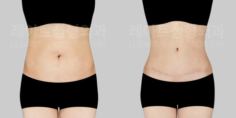 레아트 복부거상 수술 전후 비교 - 레아트 이국한 원장