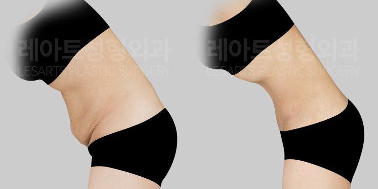 복부거상 수술을 통한 아랫배 피부 접힙 개선