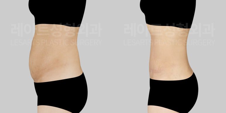 복부거상, 복벽교정,지방흡입 후기