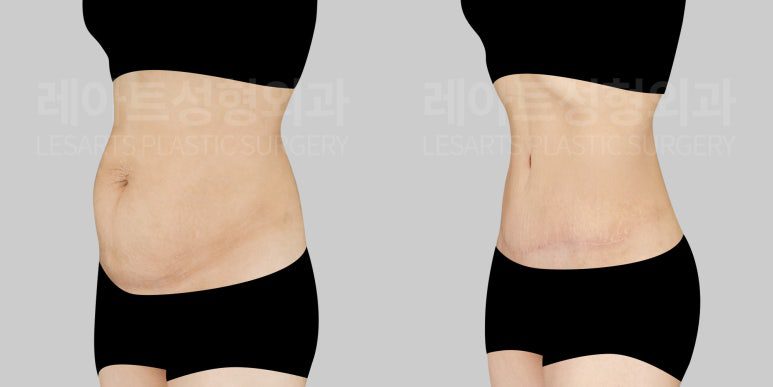 출산 후 앞복부 돌출, 처짐, 주름, 튼살개선 - 레아트 복부거상