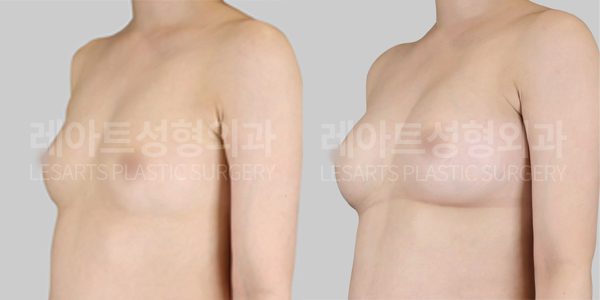 n-breast-fat-transfer-post-287