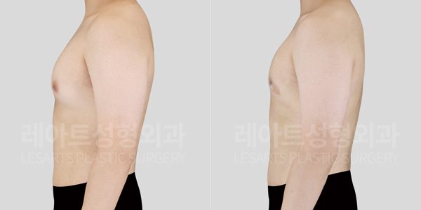 n-gynecomastia-post-285