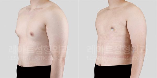 여유증 수술 전후 비교 사진 - 레아트 성형외과