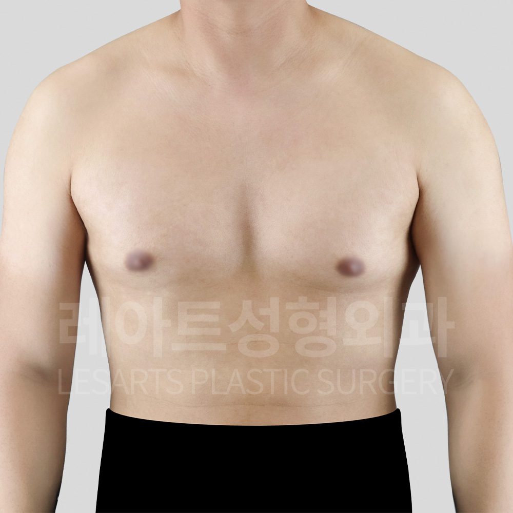 10대부터 이어진 앞가슴 돌출과 양측 멍울이 확인된 수술 전 상태