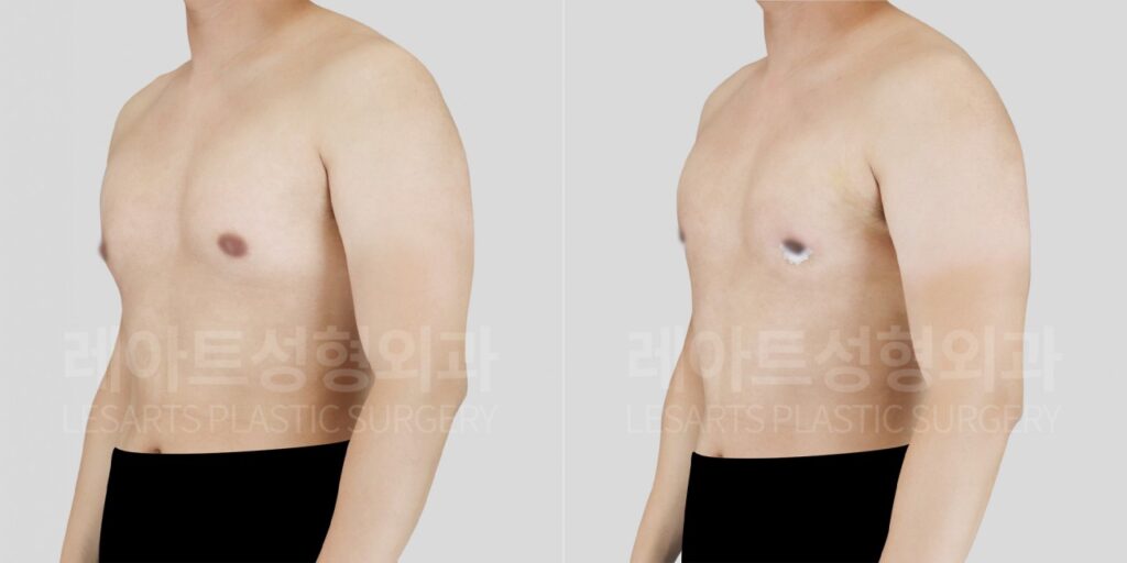 n-gynecomastia-post-289-04
