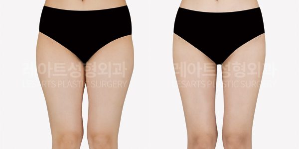 허벅지 지방흡입 전후사진 - 레아트 성형외과
