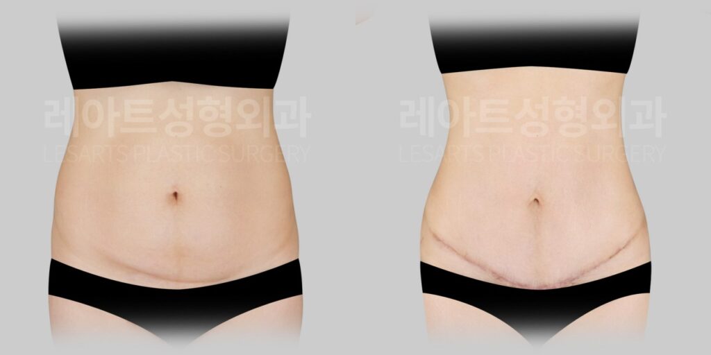 n-tummy-tuck-post-284-03