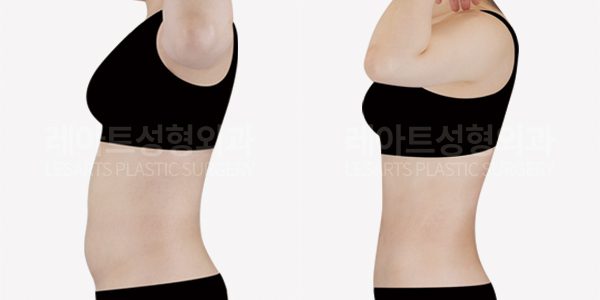 n-tummy-tuck-post-285
