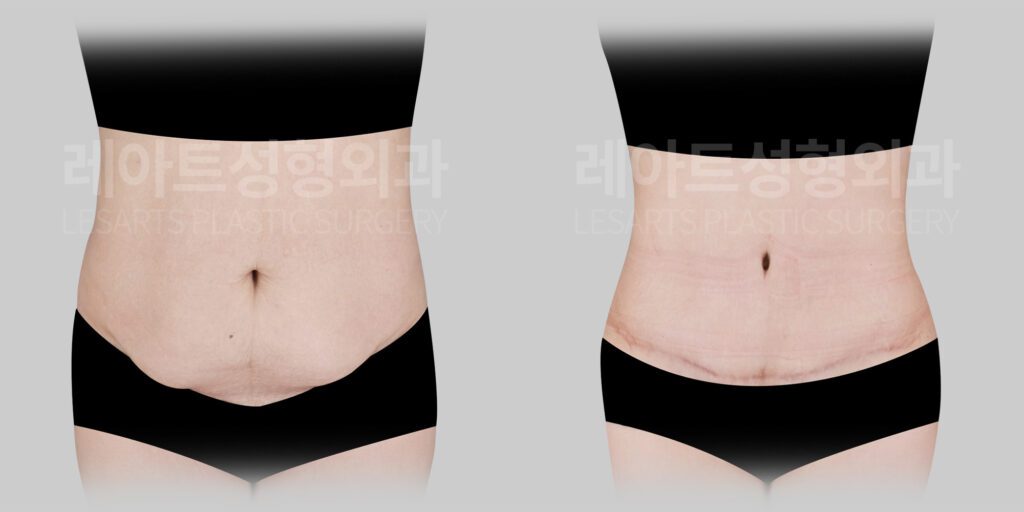 복부거상 수술 전후 비교 모습 - 레아트 성형외과