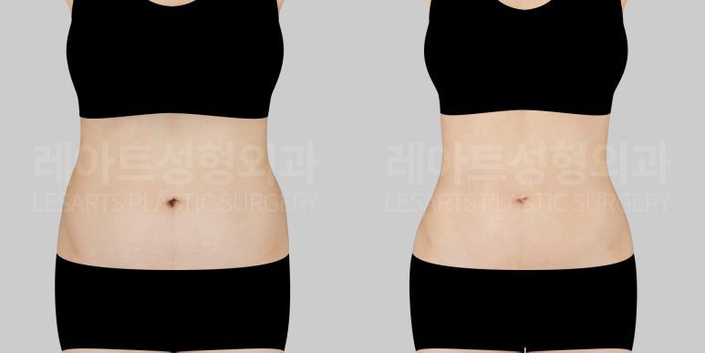 복부 지방흡입 전후사진 비교 - 레아트 성형외과