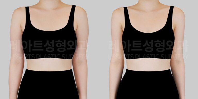 팔 지방흡입|팔, 부유방 지방흡입으로 완성하는 매끄러운 직각 어깨 라인