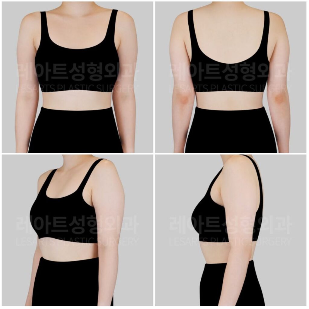 팔, 부유방 지방흡입 수술 전 체형진단
