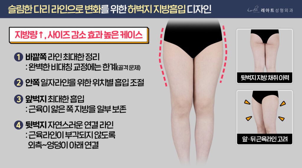 허벅지지방흡입 수술 방법 - 레아트 성형외과