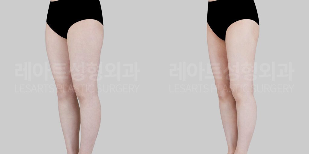 앞벅지 지방흡입 전후 - 레아트성형외과 서용승 원장